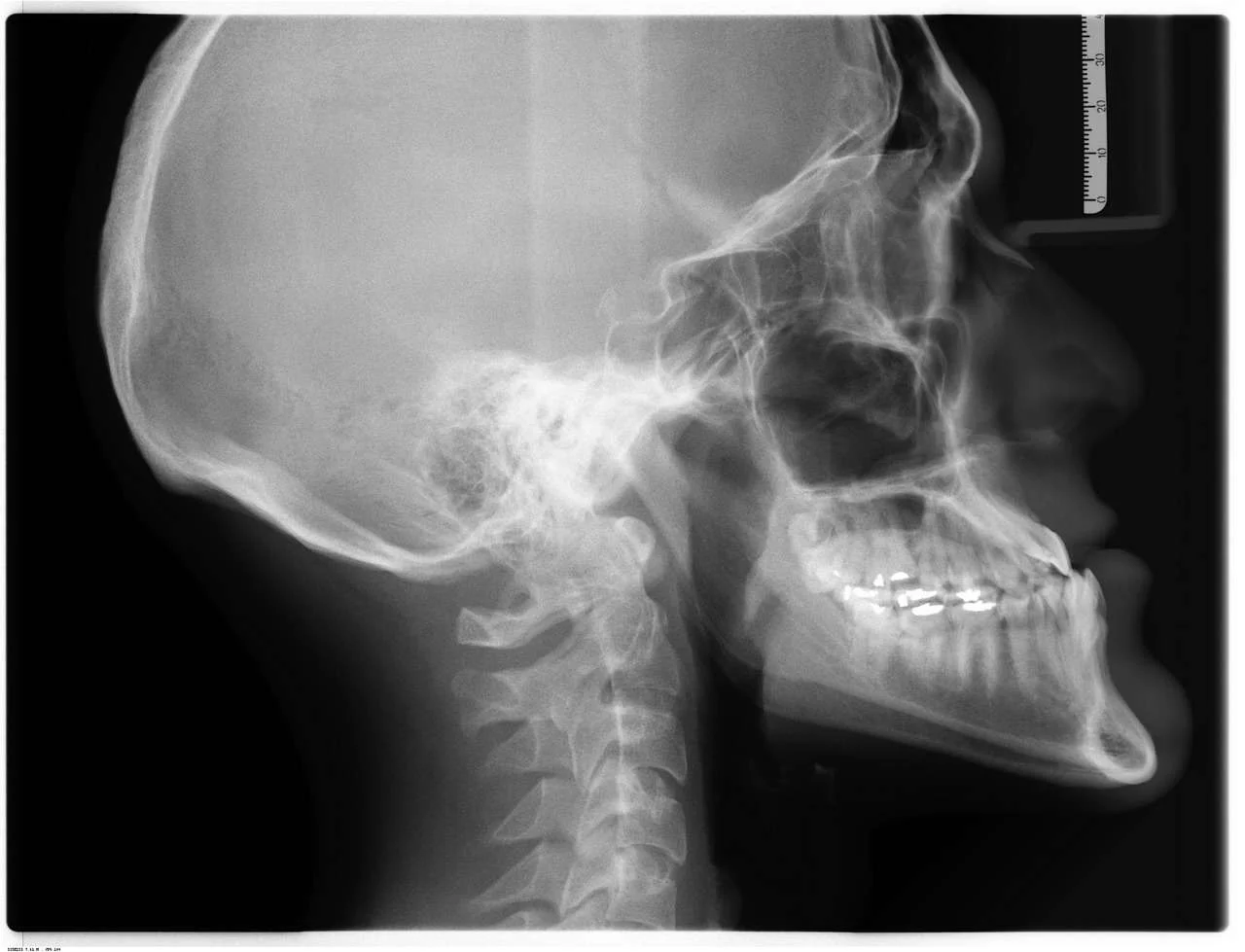 Panoramic dental x-ray image showing teeth and jaw